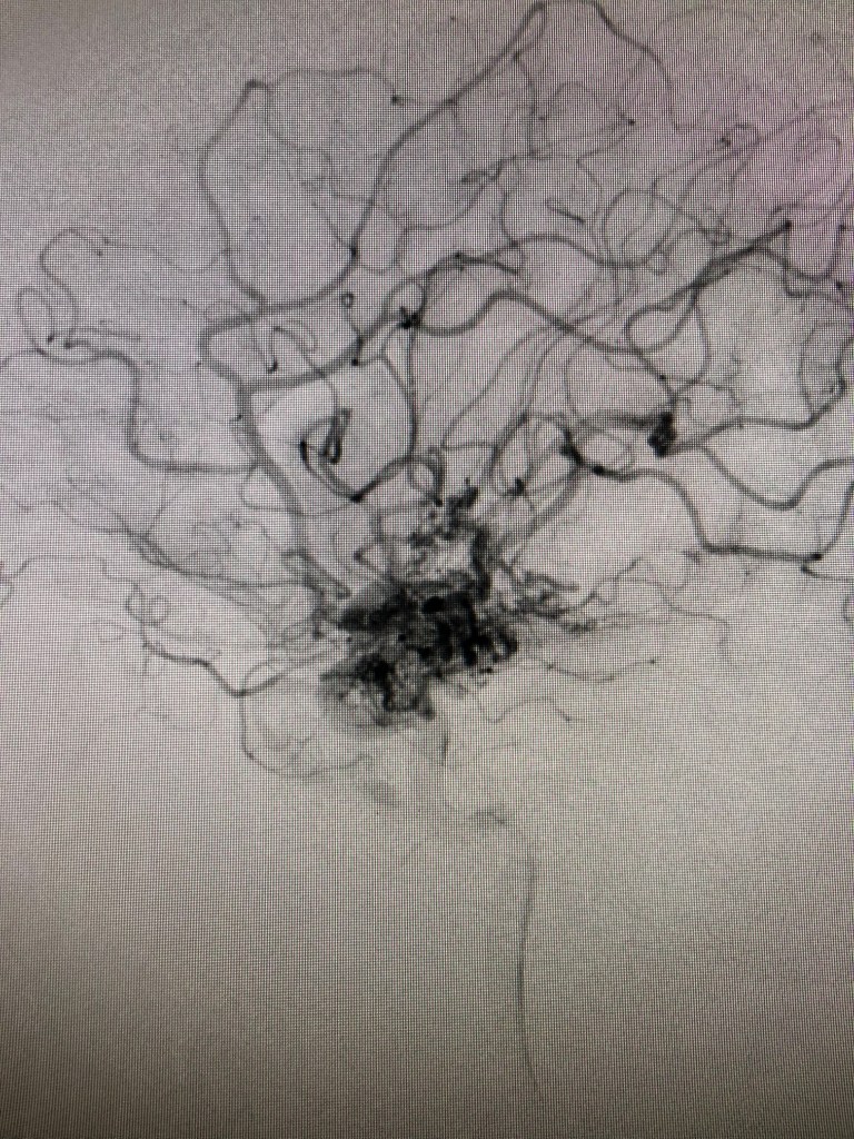 Image of an AVM (center) as seen on an angiogram