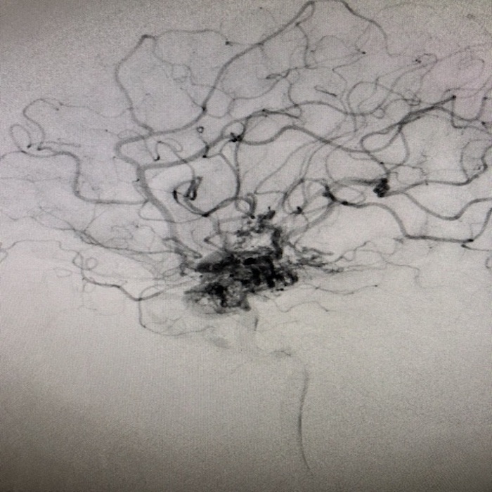 Recovery After an AVM Stroke: Insights from Two Stroke&nbsp;Survivors